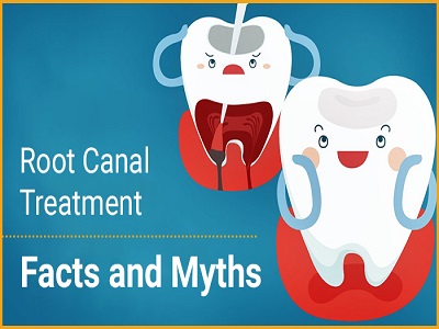 root-canal-treatment-myths-and-facts